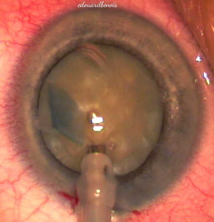 aspiration du capsulorhexis par la sonde de phako-émulsification
