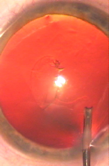 capsulorhexis à l'aiguille perfusée