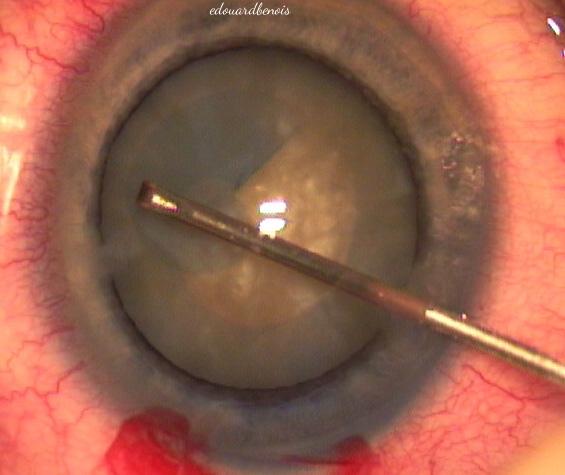 capsulorhexis au bleu trypan