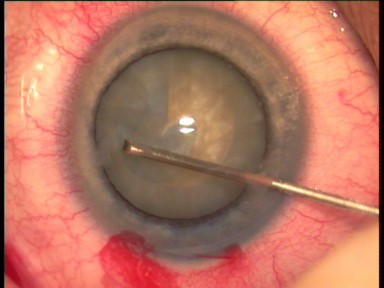 capsulorhexis cataracte blanche