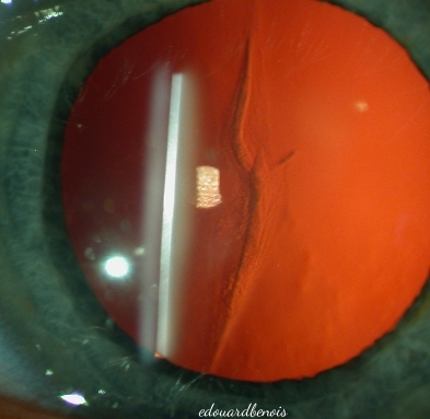 cataracte corticale