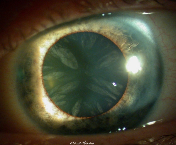 cataracte corticale