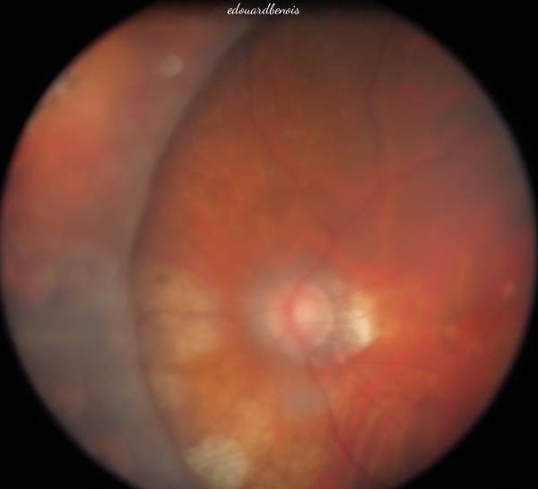 cerclage rétinien chirurgical