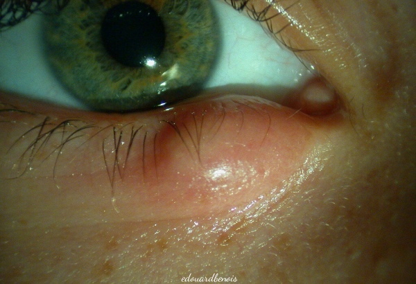 chalazion