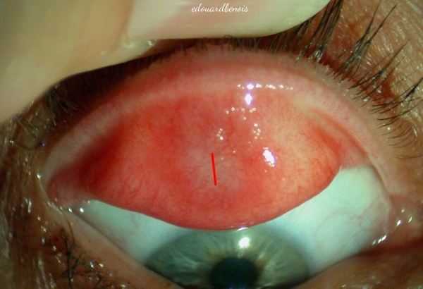 incision de chalazion