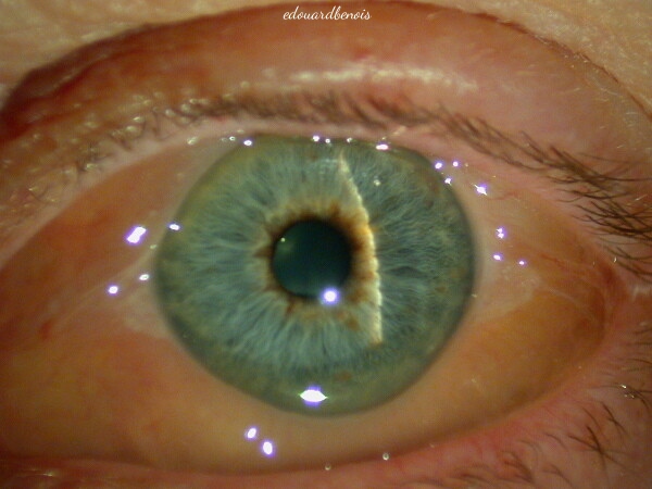 chemosis allergique
