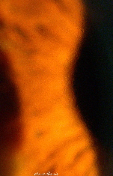 cornea guttata