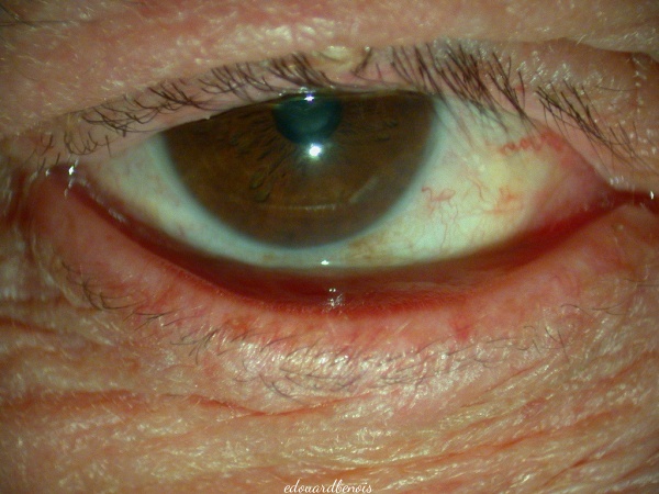 ectropion palpébral