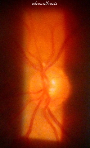 embolie artériole rétinienne
