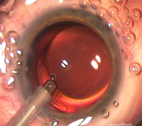évacuation du hyaluronate
