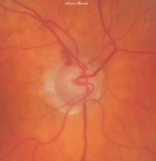 hémorragie papillaire glaucomateuse