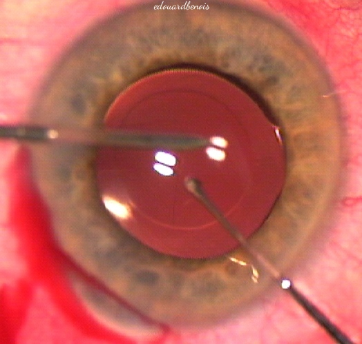 centrage du cristallin artificiel dans le sac capsulaire