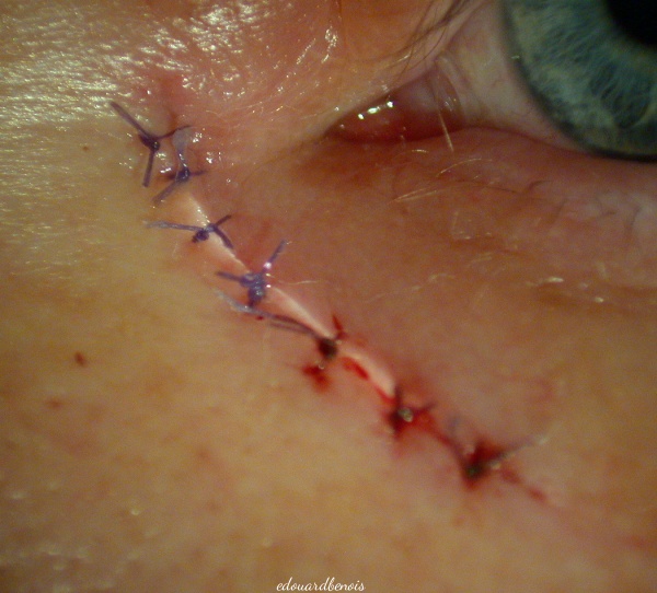 incision cutanée de dacryocystorhinostomie