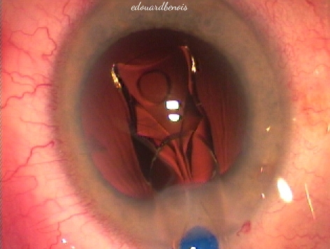 injection d'un cristallin artificiel en silicone