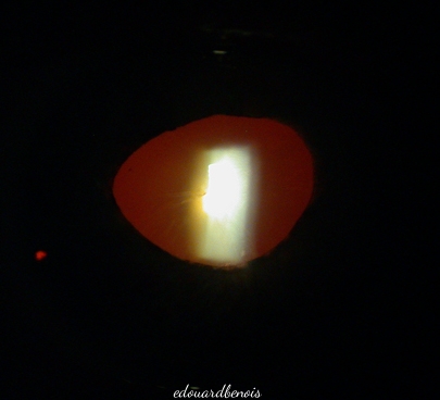 iridotomie au laser YAG