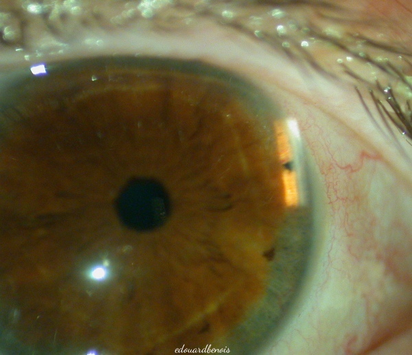 iridotomie au laser YAG