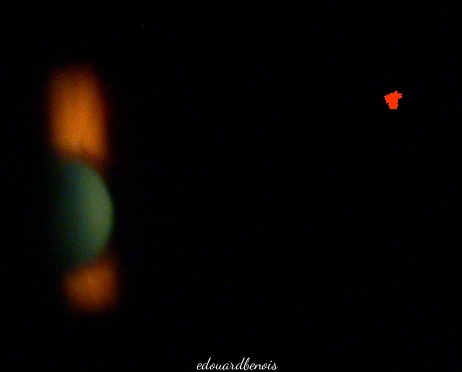 iridotomie au laser YAG