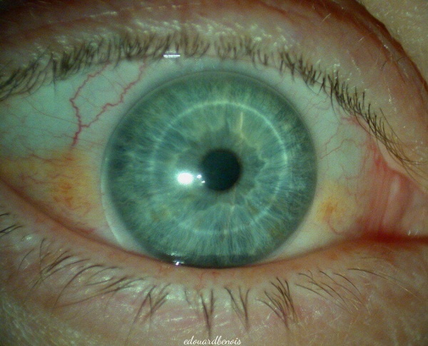 lentille de contact molle