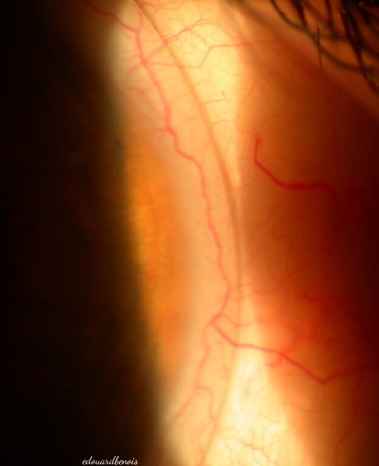 néovaisseaux sous lentille de contact molle