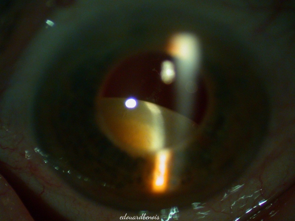 luxation de cataracte traumatique
