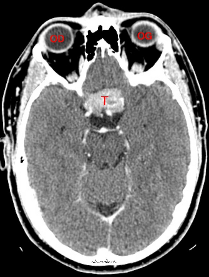 neurinome de la base du crâne