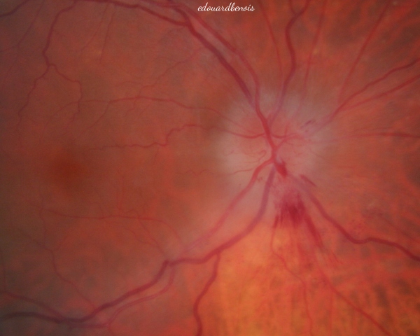 neuropathie optique ischémique antérieure aiguë