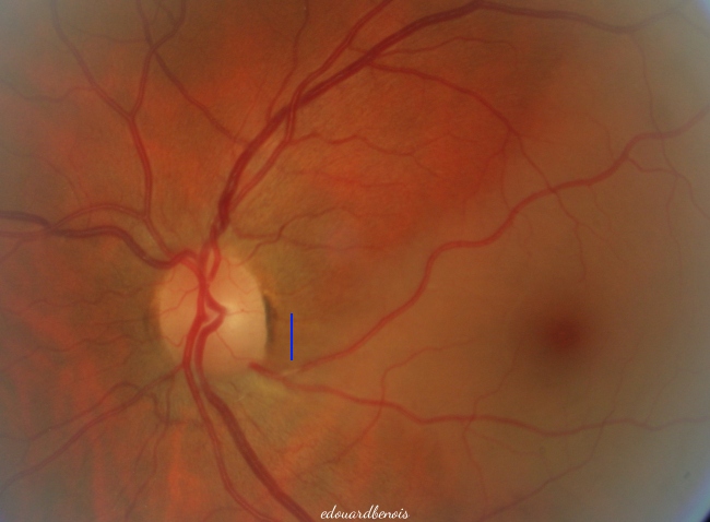 occlusion d'une artère ciliorétinienne de l'œil gauche