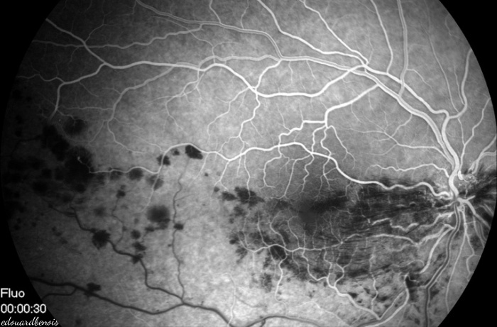 occlusion veineuse rétinienne inférieure