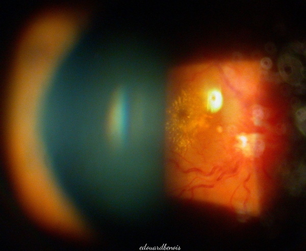 occlusion veineuse rétinienne droite