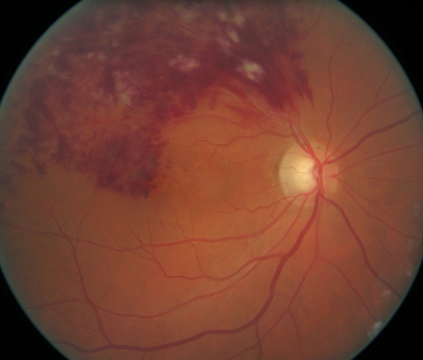 occlusion veineuse rétinienne temporale supérieure