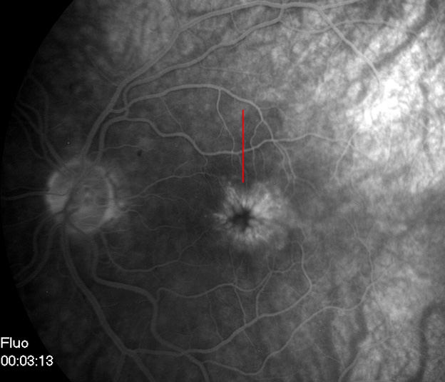 oedèmùme maculaire cystoïde en angiographie