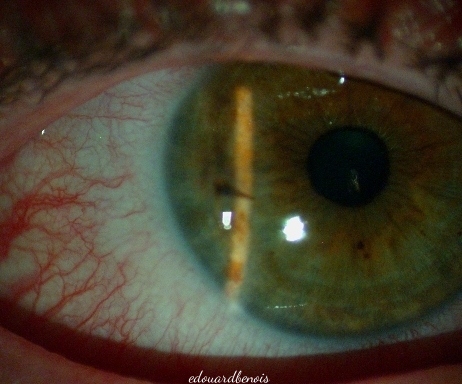 perforation oculaire par épine de ronce