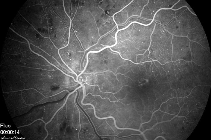 angiographie fluorescéïnique d'une  rétinopathie diabétique