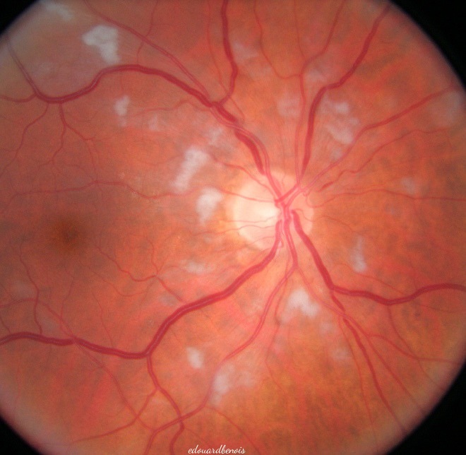rétinopathie dysorique