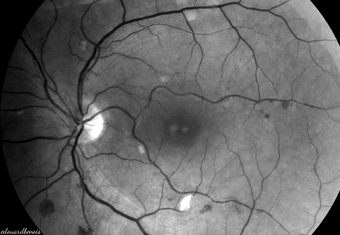 rétinopathie hypertensive