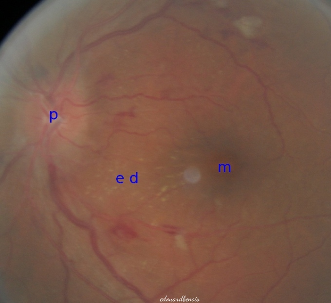 rétinopathie hypertensive