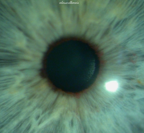rubéose irienne microscopique