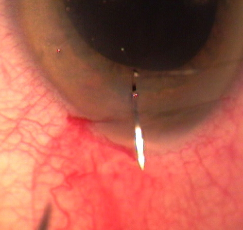 suture incision de cornée