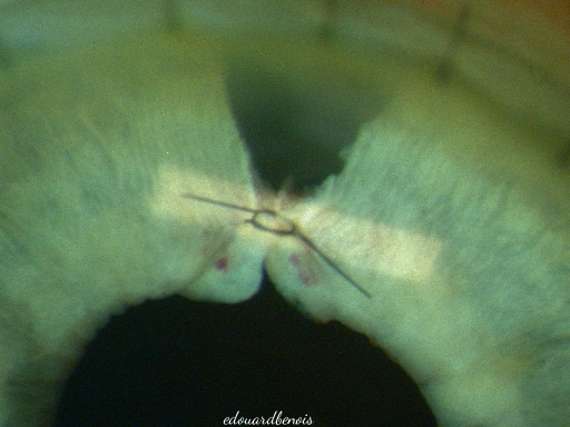 suture de l'iris
