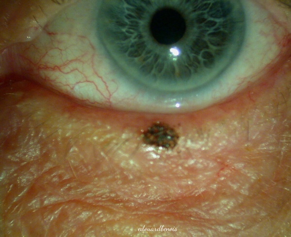verrue séborrhéique palpébrale brûlée au laser