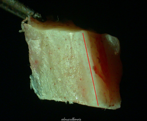 volet osseux de dacryocystorhinostomie