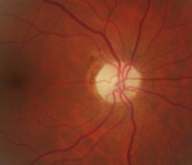 lien vers atrophie optique