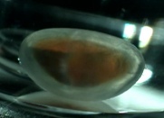 lien vers cataracte in vitro
