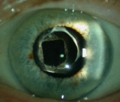 lien vers découpe au laser YAG de cataracte secondaire