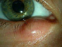 lien vers chalazion