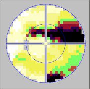 lien vers champs visuels glaucomateux