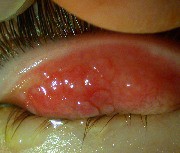 lien vers conjonctivite allergique