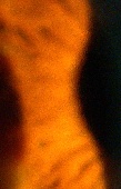 lien vers cornea guttata