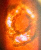 lien vers déchirure de rétine traitée au laser