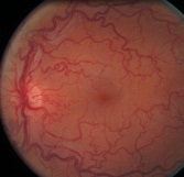 lien vers hypertension veineuse rétinienne